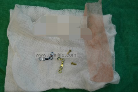 사각턱 수술 후 생길 수 있는 부작용증상과 재수술 관련 이미지 1