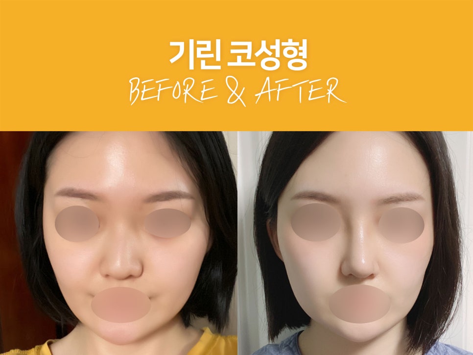 여자코성형후기 얼굴 비율까지 고려하여 관련 이미지 1