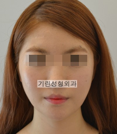 윤곽수술 시 심부볼제거 관련 이미지 2