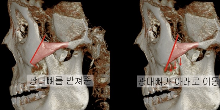 광대 부분절골- 광대비고정사례 관련 이미지 5