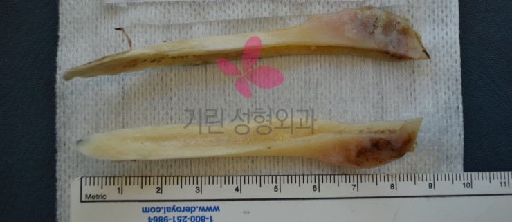 얼굴뼈로 보는 긴곡선절제술(절골된 bone) 관련 이미지 1