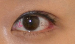 졸린눈 교정 비절개눈매교정! 관련 이미지 2