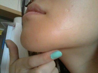 안면윤곽 후 재수술사례 : 부작용으로 인한 재수술 관련 이미지 3