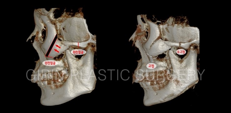 광대뼈수술하고 고정하지 않아도 안전한가요? 관련 이미지 1