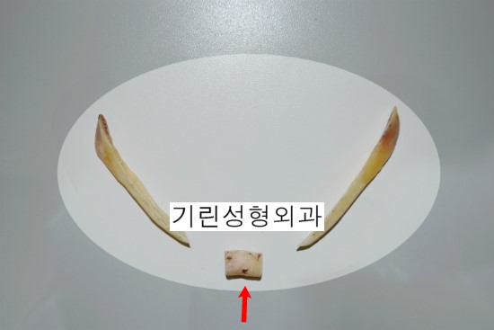안면윤곽 볼처짐에 관한 진실 : 티절골을 하면 왜 이중턱이 생길까 관련 이미지 2