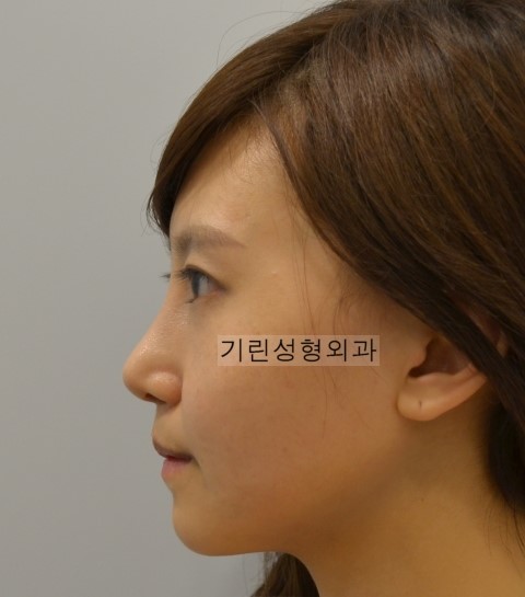 매부리코수술로 안면부에 중심을. 관련 이미지 2