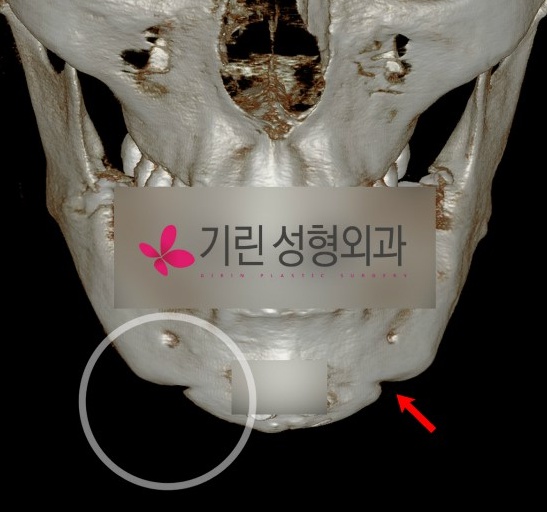 사각턱수술 후 효과가 없고 U자 얼굴형 관련 이미지 1