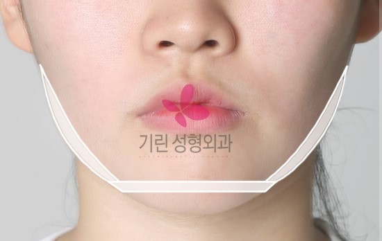 턱끝은 긴턱줄임수술 : 실제 뼈모양( 제거된 뼈가 있던 위치) 관련 이미지 1