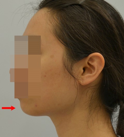 티절골로 돌출입수술의 효과가 있을까(앞턱전진과 긴곡선절제의 병행) 관련 이미지 1