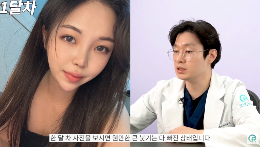 [기린성형외과] 짧고, 들린 코 탈출!_코성형 수술일지 관련 이미지 9