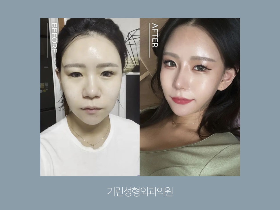 서울코성형 신중하게 정해야 관련 이미지 4