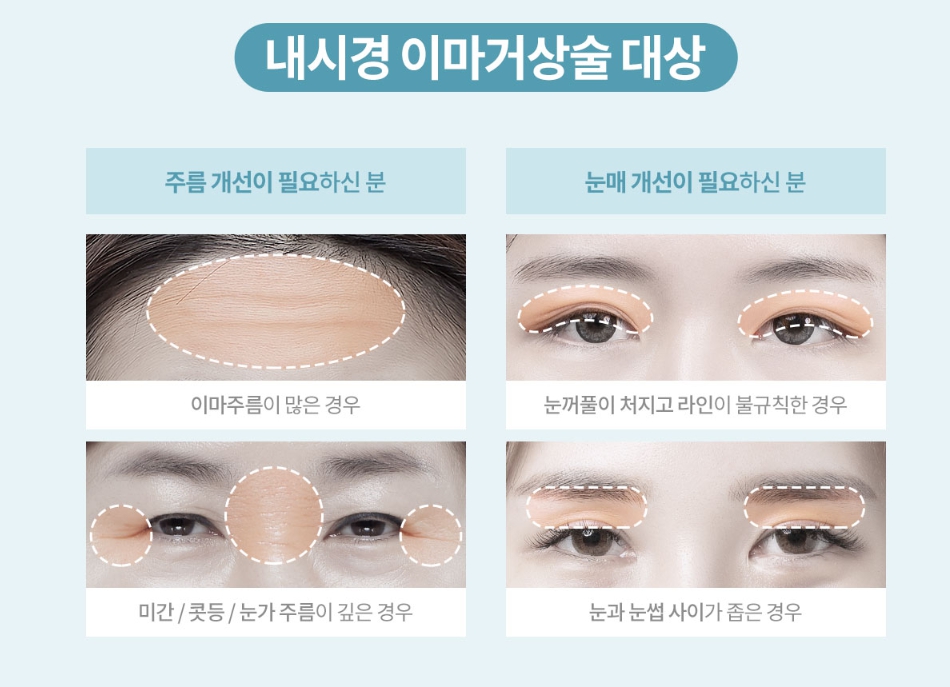 내시경이마거상술 엔도타인 효과 왜 인정받을까? 관련 이미지 6