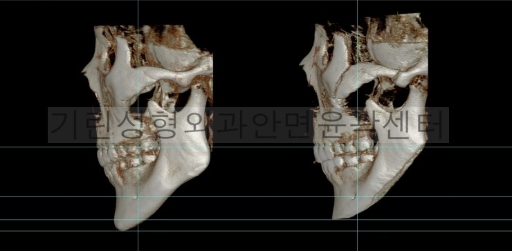 긴곡선 앞턱길이줄임+광대고정 관련 이미지 7