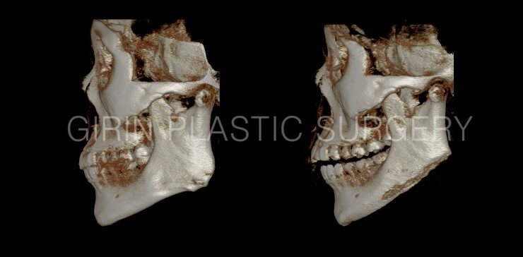 볼살과 턱이 발달한 케이스 관련 이미지 3