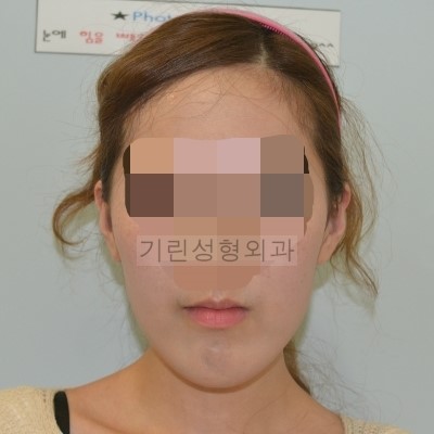 긴곡선 앞턱길이줄임+광대고정 관련 이미지 1