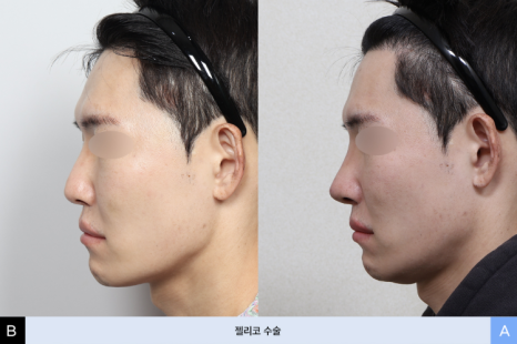 젤리코란? 비개방 코수술과 일반 코수술의 차이 관련 이미지 4