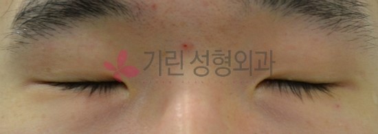 쌍꺼풀수술후기 : 일주일 경과 쌍꺼풀전후 관련 이미지 1