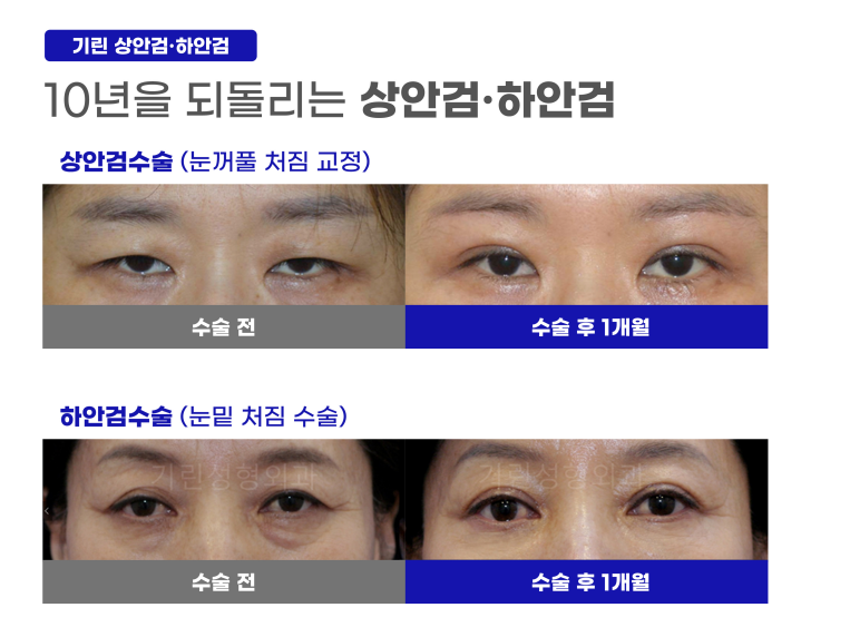 상하안검수술 인상을 바꾸기 위해 관련 이미지 4