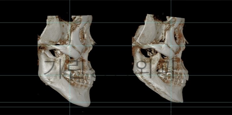 사각턱재수술 길이줄임 7일경과사진 관련 이미지 5