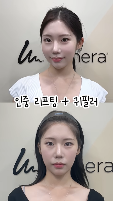 기린성형외과 인중리프팅 + 귀필러 관련 이미지 1