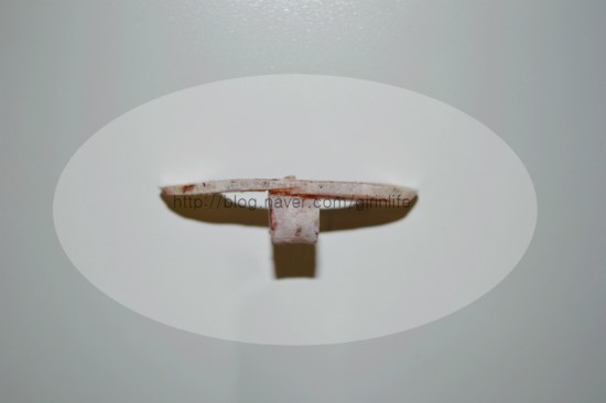 티절골은 어떤 수술일까 (수술후bone) 관련 이미지 1