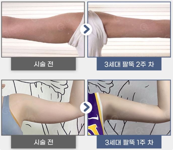 강남지방분해주사, 의미 없는 유형은? 관련 이미지 7