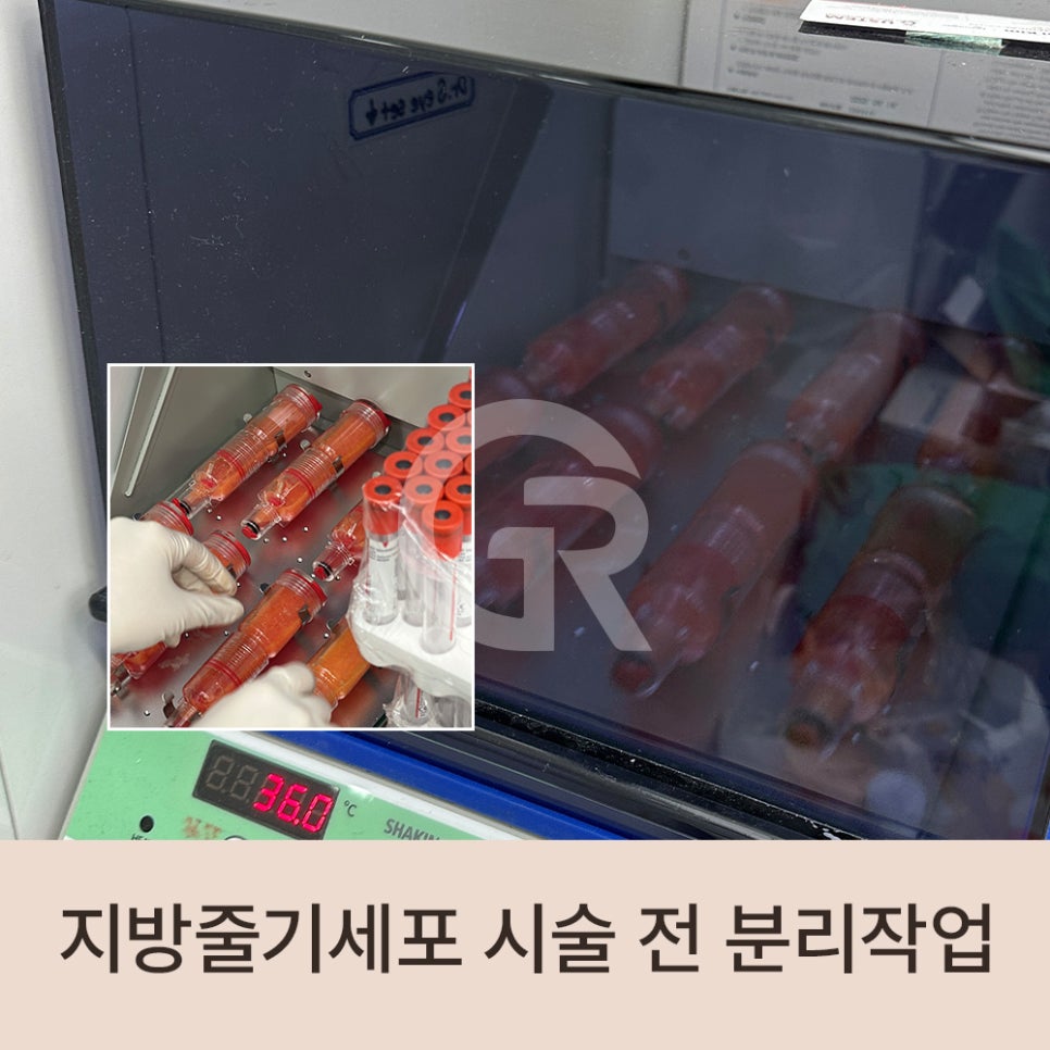 "머리숱이 없어요" 가르마 탈모 환자 줄기세포 주사 관련 이미지 5