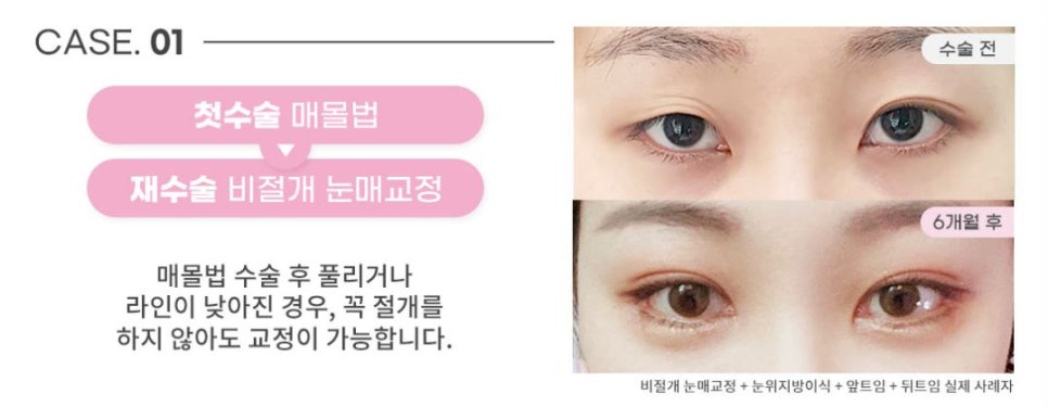 소세지눈재수술? 더는 실패 없는 비법 1가지 관련 이미지 3