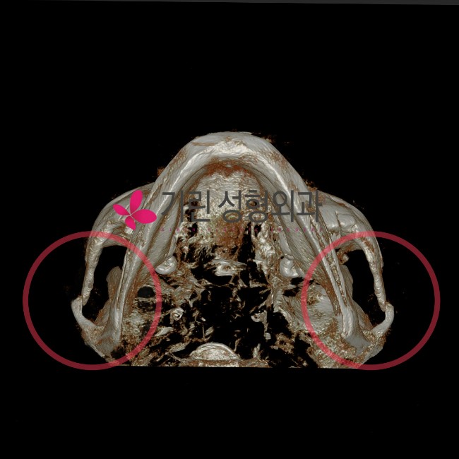 고정과 비고정이 광대축소술 후 부작용과 관련있을까 관련 이미지 2
