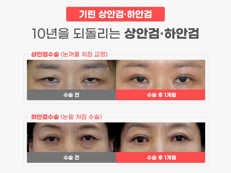 중년눈수술 어려지는 방법 중 하나? 관련 이미지 2