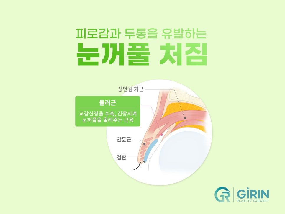 상안검수술잘하는곳 알아본다면 관련 이미지 5