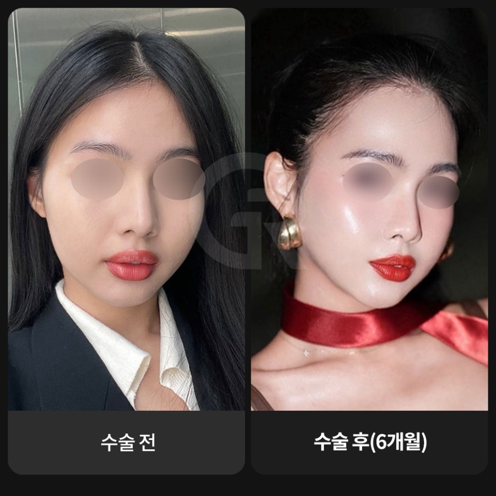 광대가 큰 얼굴, 축소술은 인상을 조율하는 기준점입니다 관련 이미지 9
