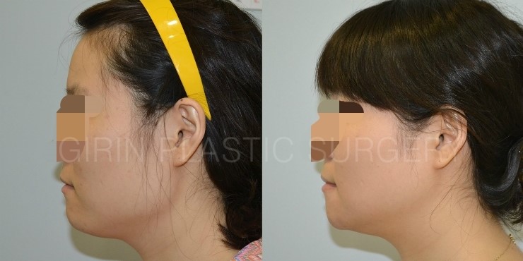 긴곡선브이라인 16일째 경과 관련 이미지 3