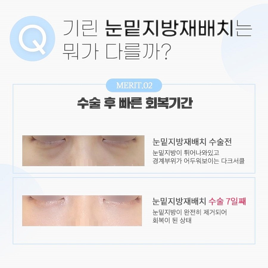눈밑지방재배치 레이저 vs 수술후, 그동안 걱정했다면 관련 이미지 6