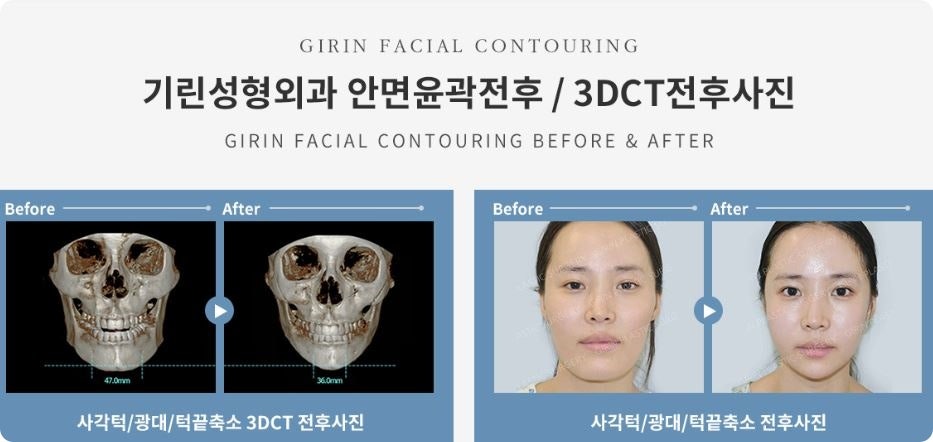 안면윤곽후기? 사실 도움 안 되는 이유 관련 이미지 6