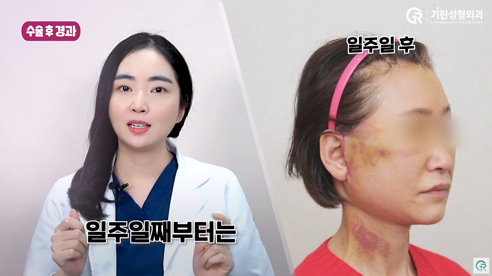 [기린성형외과의원] 부모님들 사이에서 유행하는 성형_안면거상 수술일지 관련 이미지 5