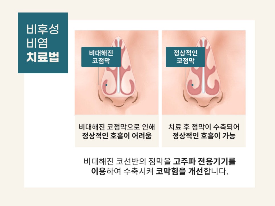 기능코수술 불편함을 해결하자 관련 이미지 6