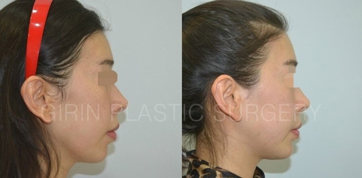 긴곡선절제술 6주차 앞턱변화 모습 관련 이미지 3