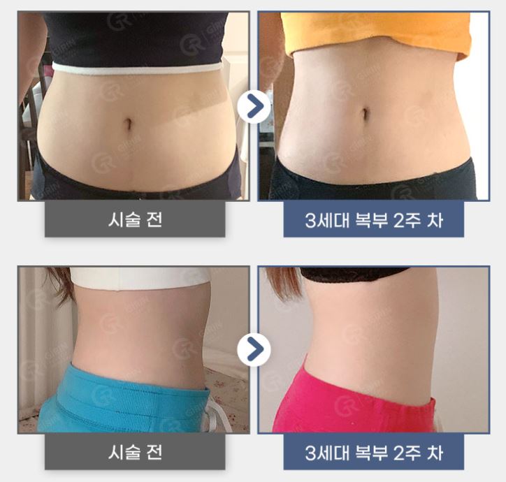 복부지방분해주사? 나에게도 잘 맞을까? 관련 이미지 4