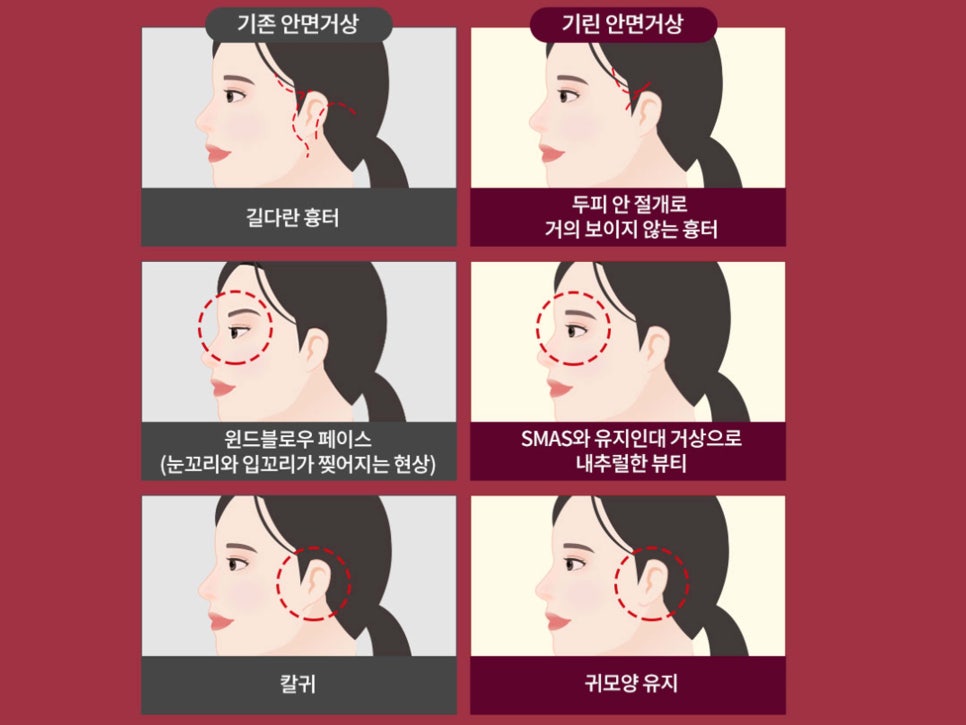 안면거상수술 효과 확실하려면 관련 이미지 14