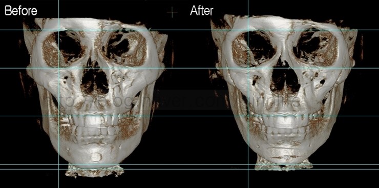 긴곡선절골로 앞턱길이를 함께 줄인 경우 관련 이미지 2