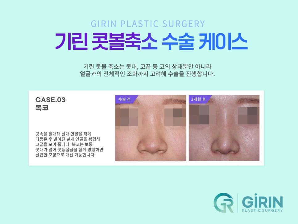콧볼축소술 뭉툭한 코 개선을 위해 관련 이미지 5