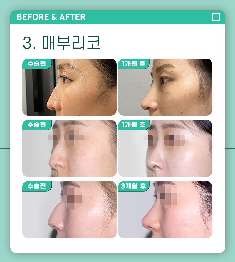 코성형수술비용 확실한 기준으로 정확하게 관련 이미지 3