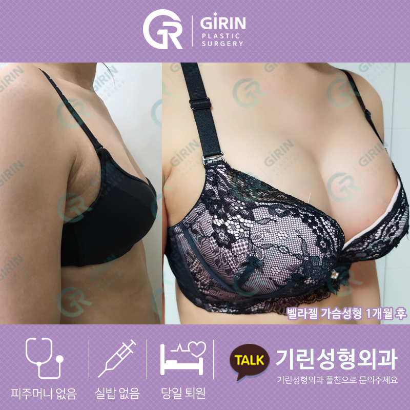 처진 가슴도 한방에! 기린 성형외과 송재용 원장 가슴 수술 후기 관련 이미지 3