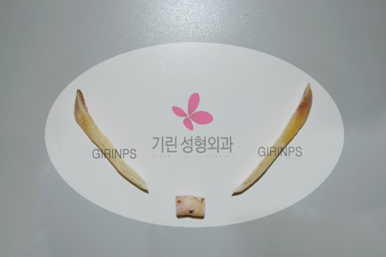 티절골로 제거된 실제 뼈모양과 위치 관련 이미지 2