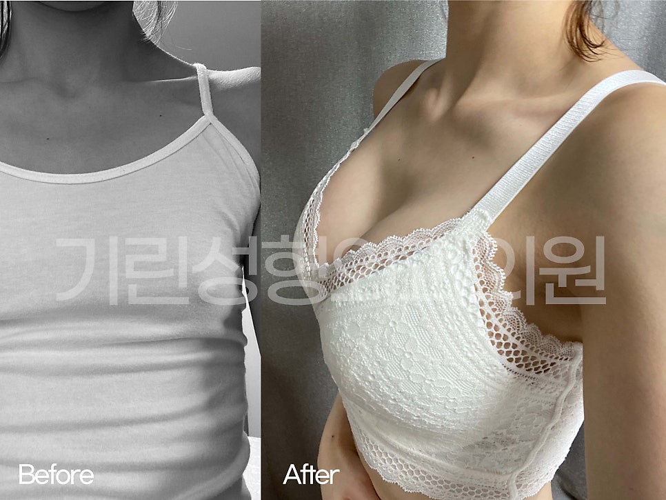 가슴성형전후 비교가 필요하다면 관련 이미지 3