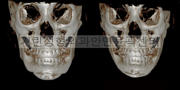 [이차각재수술사례] 긴곡선절제술을 통한 이차각제거, V라인수술 관련 이미지 1