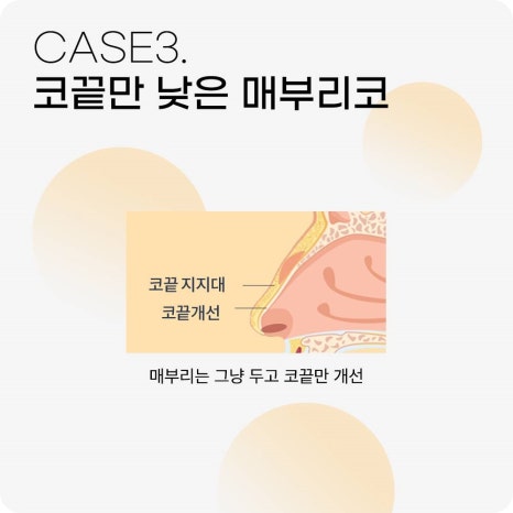 매부리코수술? 콧대만 깎는다고 해결 될까? 관련 이미지 7