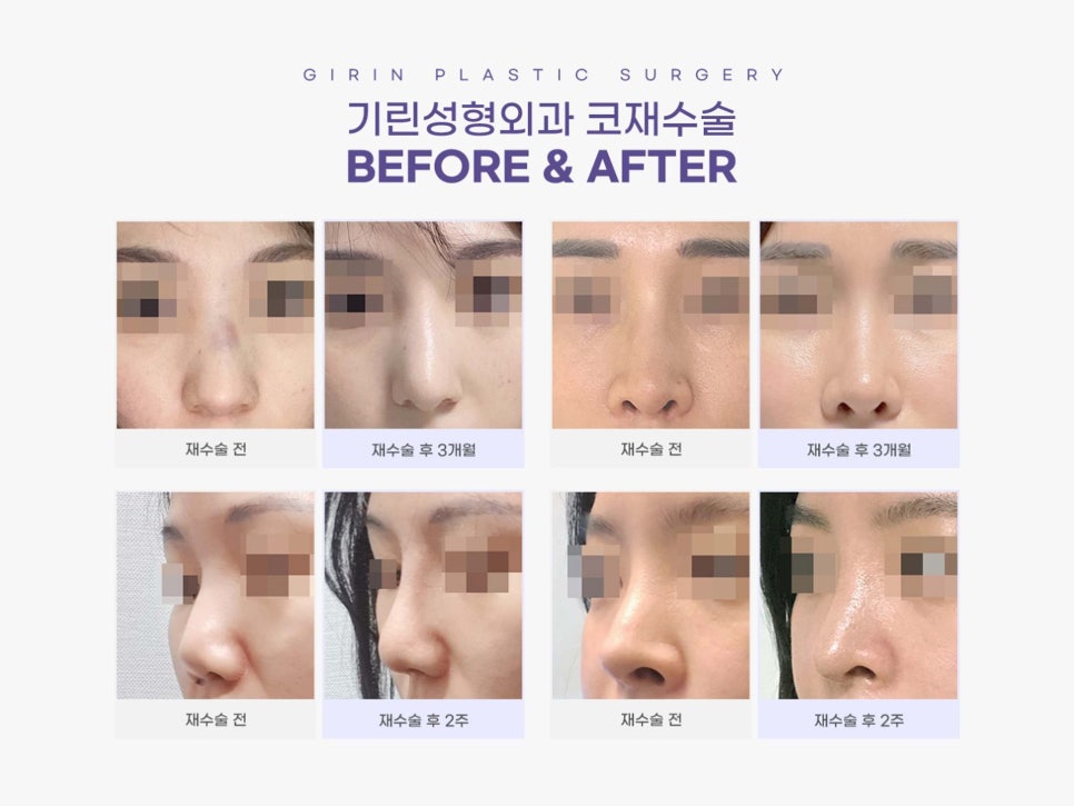 코재수술성형외과 신중하게 선택해 관련 이미지 6