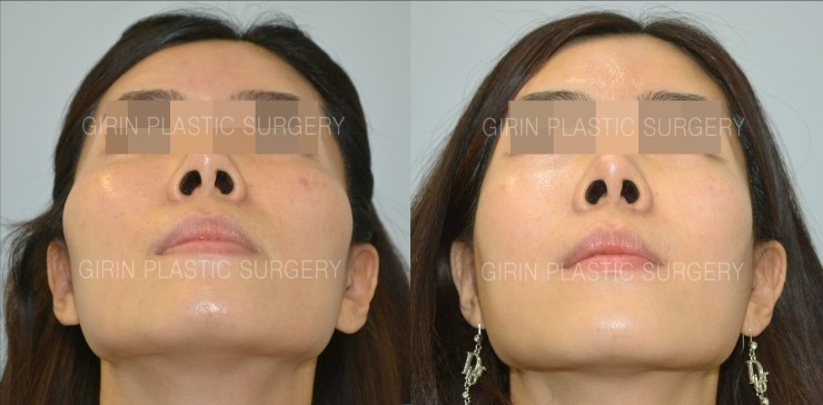 앞광대가 크게 발달한 유형 관련 이미지 2